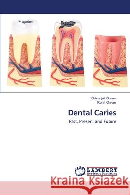 Dental Caries Shivanjali Grover, Rohit Grover 9786200539717