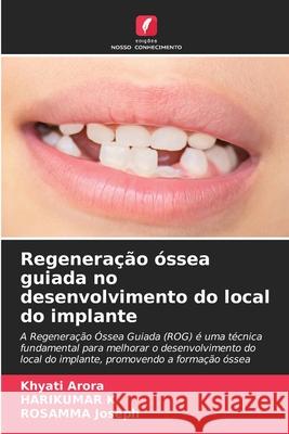 Regeneração óssea guiada no desenvolvimento do local do implante Arora, Khyati, K, HARIKUMAR, Joseph, ROSAMMA 9786200710949