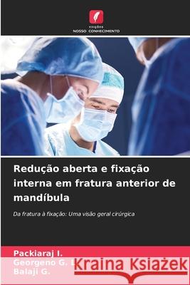 Redução aberta e fixação interna em fratura anterior de mandíbula I., Packiaraj, G. L., Georgeno, G., Balaji 9786200819611 Edições Nosso Conhecimento
