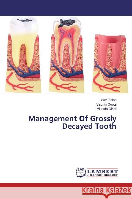 Management Of Grossly Decayed Tooth Talan, Janvi; Gupta, Sachin; Nikhil, Vineeta 9786202062879 LAP Lambert Academic Publishing