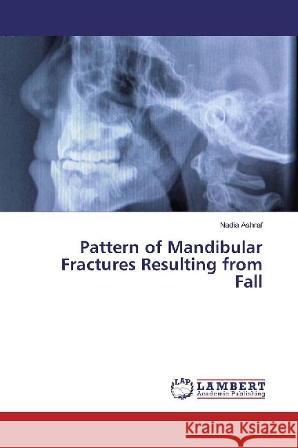 Pattern of Mandibular Fractures Resulting from Fall Ashraf, Nadia 9786202063685