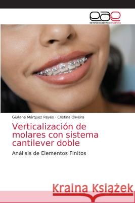 Verticalización de molares con sistema cantilever doble Márquez Reyes, Giuliana 9786202132251 Editorial Académica Española