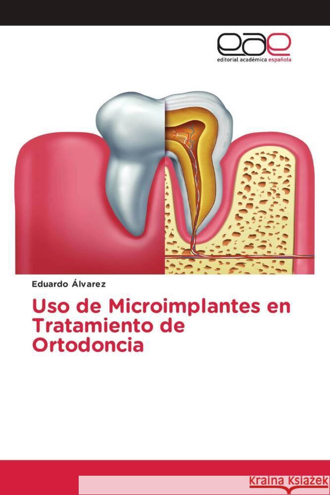 Uso de Microimplantes en Tratamiento de Ortodoncia Álvarez, Eduardo 9786202149181