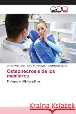 Osteonecrosis de los maxilares Vidal Real, Carmen 9786202233972 Editorial Académica Española