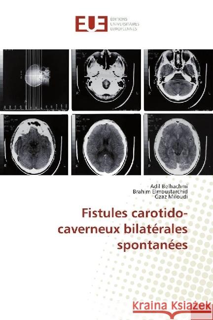 Fistules carotido-caverneux bilatérales spontanées Belhachmi, Adil; Elmoustarchid, Brahim; Miloudi, Gzaz 9786202265034