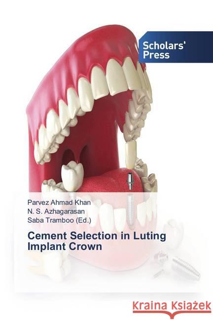 Cement Selection in Luting Implant Crown Khan, Parvez Ahmad; Azhagarasan, N. S. 9786202306027 Scholar's Press