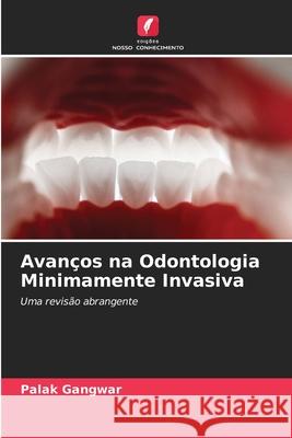 Avanços na Odontologia Minimamente Invasiva Gangwar, Palak 9786202376372 Edições Nosso Conhecimento