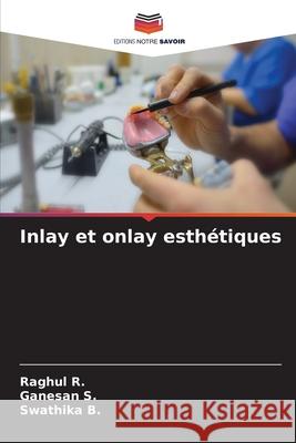 Inlay et onlay esthétiques R., Raghul, S., Ganesan, B., Swathika 9786202419833 Editions Notre Savoir