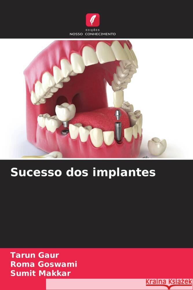 Sucesso dos implantes Gaur, Tarun, Goswami, Roma, Makkar, Sumit 9786202666398 Edições Nosso Conhecimento