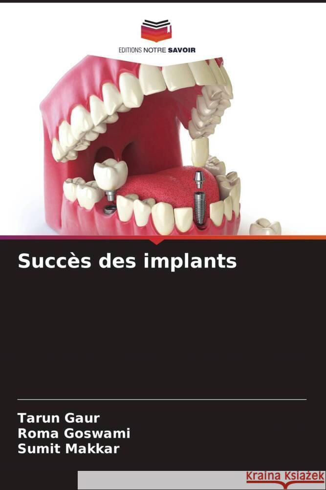 Succès des implants Gaur, Tarun, Goswami, Roma, Makkar, Sumit 9786202670760 Editions Notre Savoir