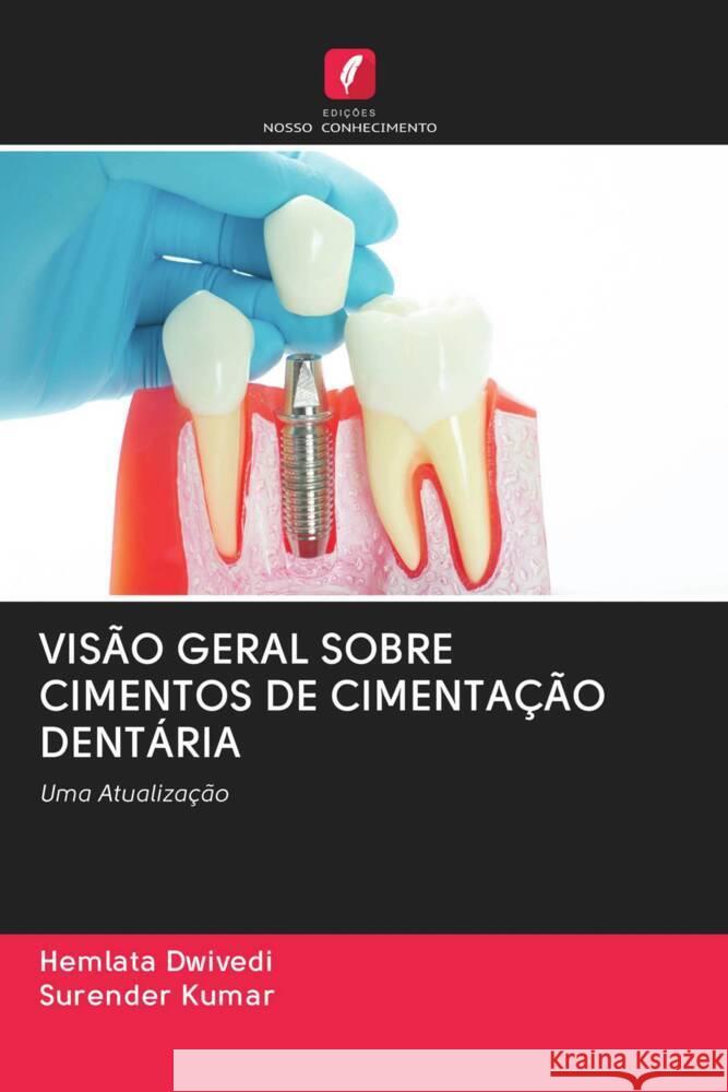 VISÃO GERAL SOBRE CIMENTOS DE CIMENTAÇÃO DENTÁRIA DWIVEDI, HEMLATA, Kumar, Surender 9786202715645