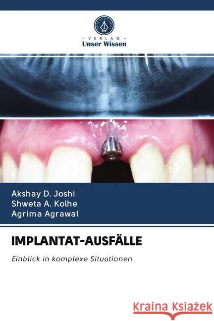 IMPLANTAT-AUSFÄLLE Joshi, Akshay D.; Kolhe, Shweta A.; Agrawal, Agrima 9786202757430