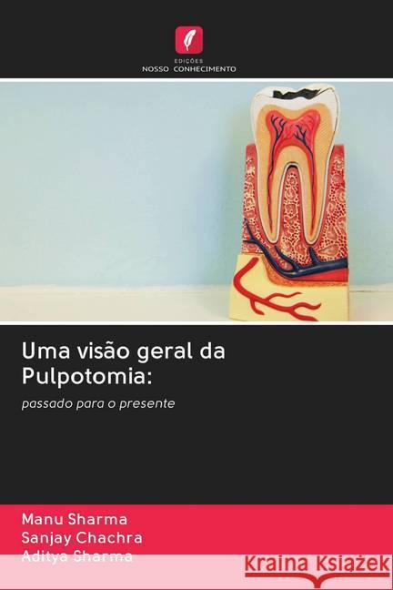 Uma visão geral da Pulpotomia: Sharma, Manu; Chachra, Sanjay; Sharma, Aditya 9786202766807 Edicoes Nosso Conhecimento