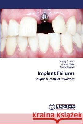 Implant Failures Akshay D. Joshi Shweta Kolhe Agrima Agarwal 9786202795166