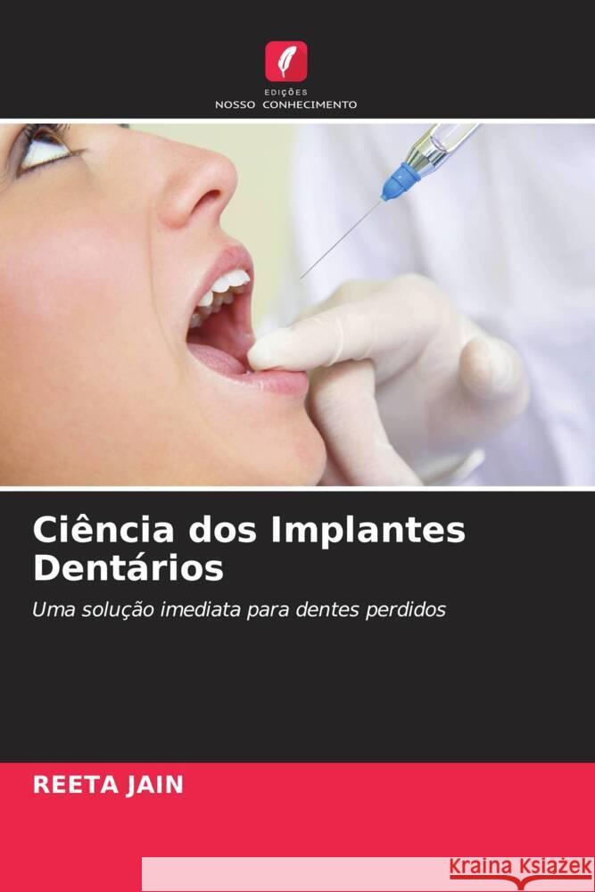 Ciência dos Implantes Dentários Jain, Reeta 9786202954471