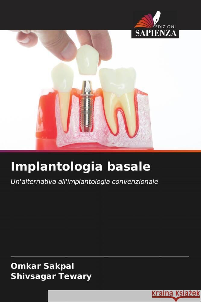 Implantologia basale Sakpal, Omkar, Tewary, Shivsagar 9786202981736 Edizioni Sapienza