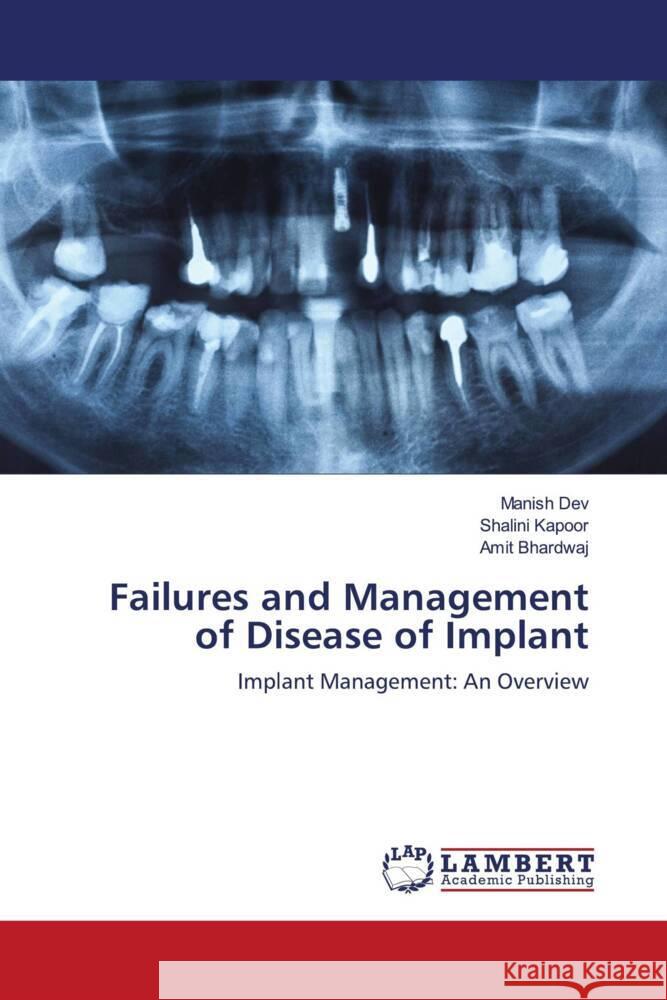 Failures and Management of Disease of Implant Dev, Manish, Kapoor, Shalini, Bhardwaj, Amit 9786203042153