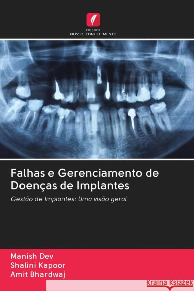 Falhas e Gerenciamento de Doenças de Implantes Dev, Manish, Kapoor, Shalini, Bhardwaj, Amit 9786203050783