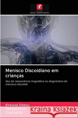 Menisco Discoidiano em crianças Khaoula Sibbou, Yassine Smiti, Chat Latifa 9786203127614 Edicoes Nosso Conhecimento