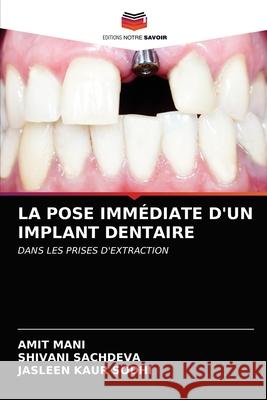 La Pose Immédiate d'Un Implant Dentaire Mani, Amit 9786203216479