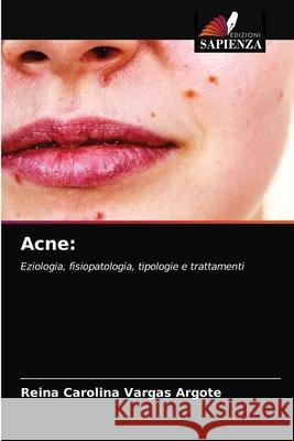 Acne Reina Carolina Varga 9786203482515 Edizioni Sapienza