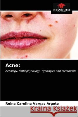 Acne Reina Carolina Varga 9786203482546 Our Knowledge Publishing