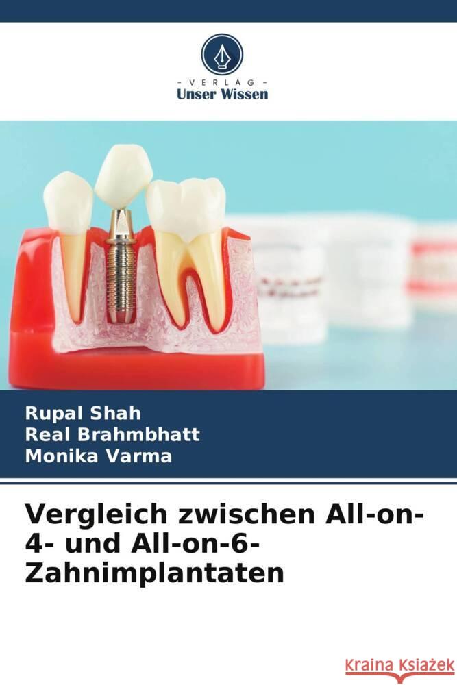 Vergleich zwischen All-on-4- und All-on-6-Zahnimplantaten Rupal Shah Real Brahmbhatt Monika Varma 9786203553048