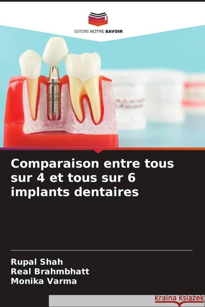 Comparaison entre tous sur 4 et tous sur 6 implants dentaires Rupal Shah Real Brahmbhatt Monika Varma 9786203553093