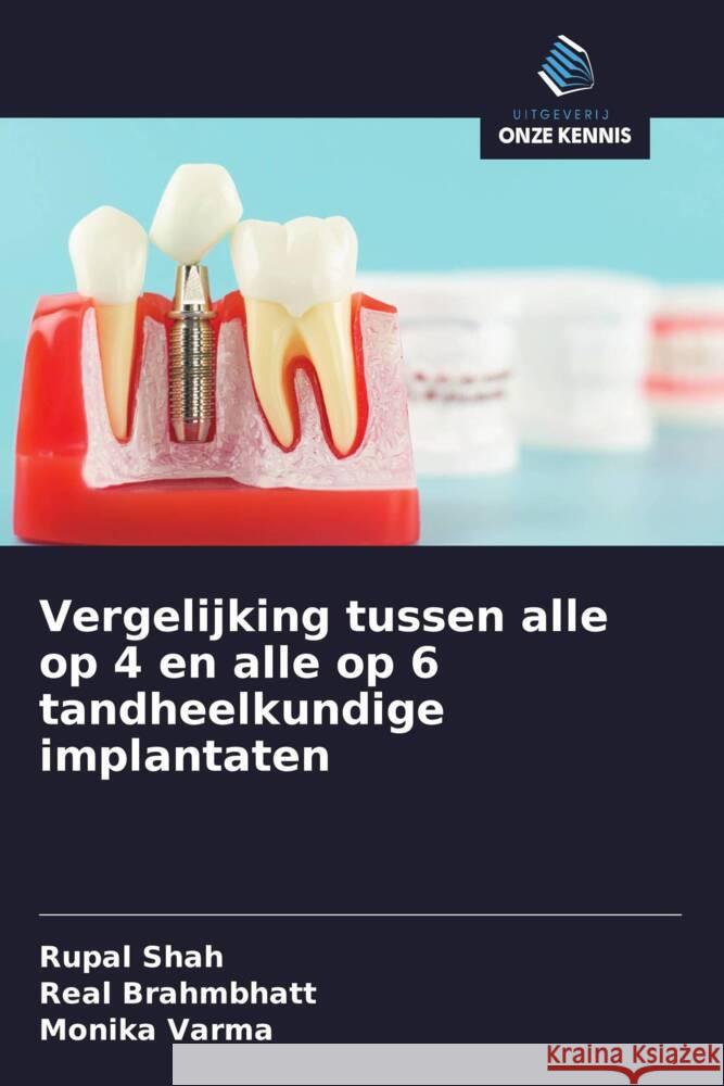 Vergelijking tussen alle op 4 en alle op 6 tandheelkundige implantaten Shah, Rupal, BRAHMBHATT, REAL, VARMA, MONIKA 9786203553116