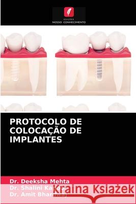 Protocolo de Colocação de Implantes Dr Deeksha Mehta, Dr Shalini Kapoor, Dr Amit Bhardwaj 9786203607482 Edicoes Nosso Conhecimento