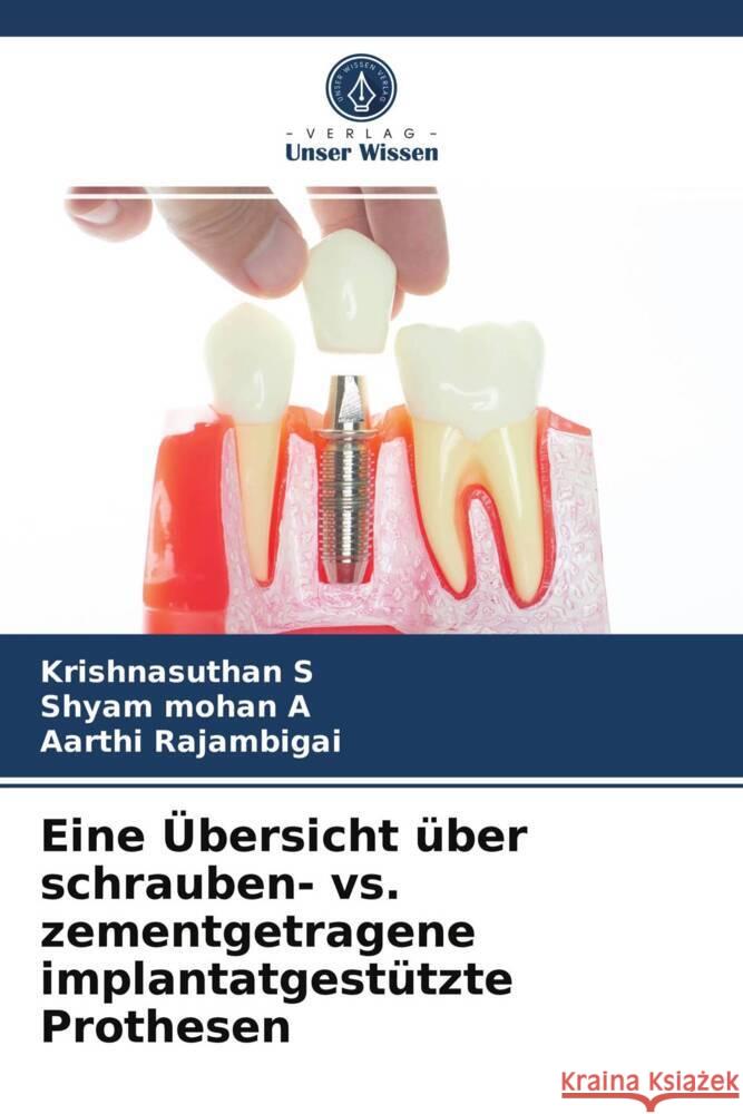 Eine Übersicht über schrauben- vs. zementgetragene implantatgestützte Prothesen S, Krishnasuthan, A, Shyam Mohan, Rajambigai, Aarthi 9786203734867