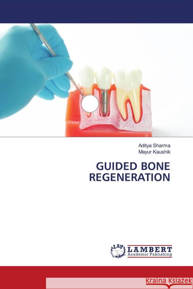 GUIDED BONE REGENERATION Sharma, Aditya, Kaushik, Mayur 9786203856378