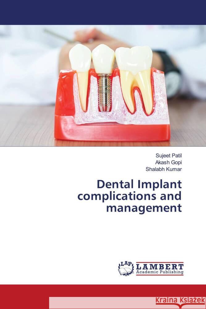 Dental Implant complications and management Sujeet Patil Akash Gopi Shalabh Kumar 9786203870589