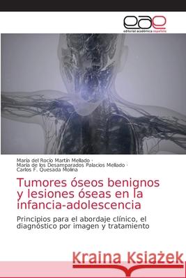 Tumores óseos benignos y lesiones óseas en la infancia-adolescencia Martín Mellado, María del Rocío 9786203871999 Editorial Academica Espanola