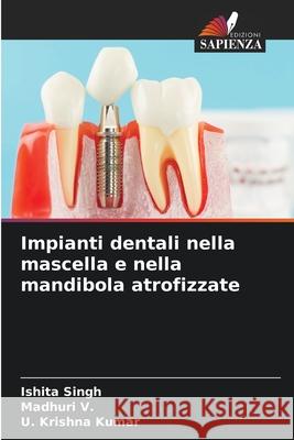 Impianti dentali nella mascella e nella mandibola atrofizzate Singh, Ishita, V., Madhuri, Kumar, U. Krishna 9786203919387