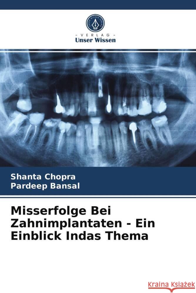 Misserfolge Bei Zahnimplantaten - Ein Einblick Indas Thema Chopra, Shanta, Bansal, Pardeep 9786204003894 Verlag Unser Wissen