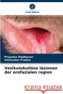 Vesikulobullöse läsionen der orofazialen region Priyanka Madhavan, Vishnudas Prabhu 9786204086996 Verlag Unser Wissen