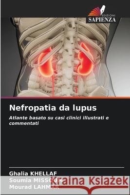 Nefropatia da lupus Ghalia Khellaf, Soumia Missoum, Mourad Lahmar 9786204100517