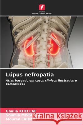 Lúpus nefropatia Ghalia Khellaf, Soumia Missoum, Mourad Lahmar 9786204100524 Edicoes Nosso Conhecimento