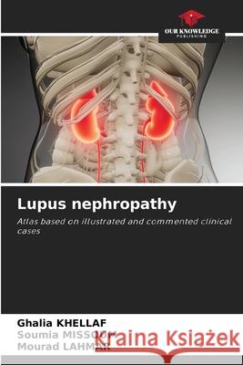 Lupus nephropathy Ghalia Khellaf, Soumia Missoum, Mourad Lahmar 9786204100531