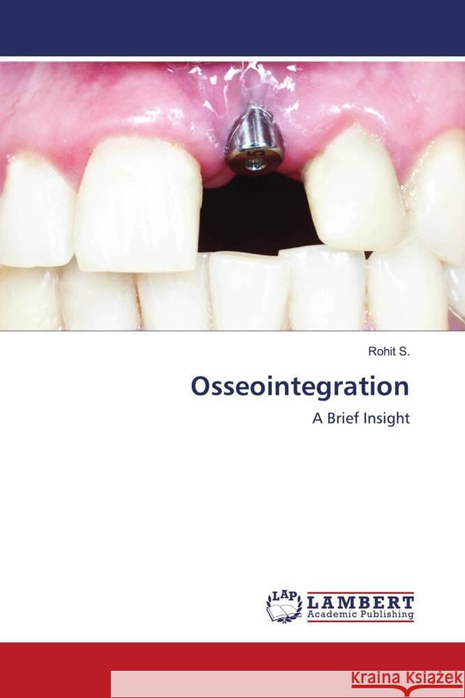 Osseointegration S., Rohit 9786204184647 LAP Lambert Academic Publishing