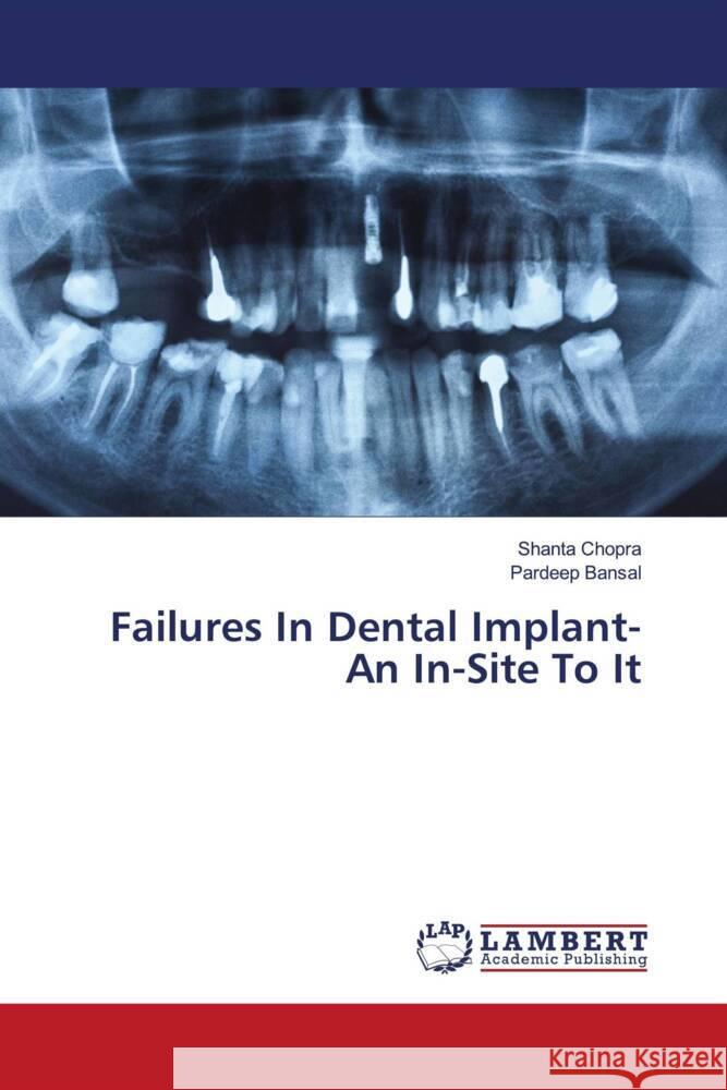 Failures In Dental Implant- An In-Site To It Chopra, Shanta, Bansal, Pardeep 9786204198057 LAP Lambert Academic Publishing