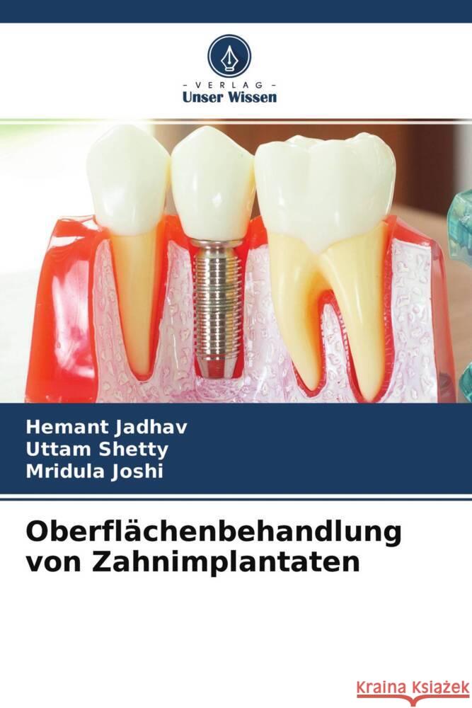 Oberflächenbehandlung von Zahnimplantaten Jadhav, Hemant, Shetty, Uttam, Joshi, Mridula 9786204219325