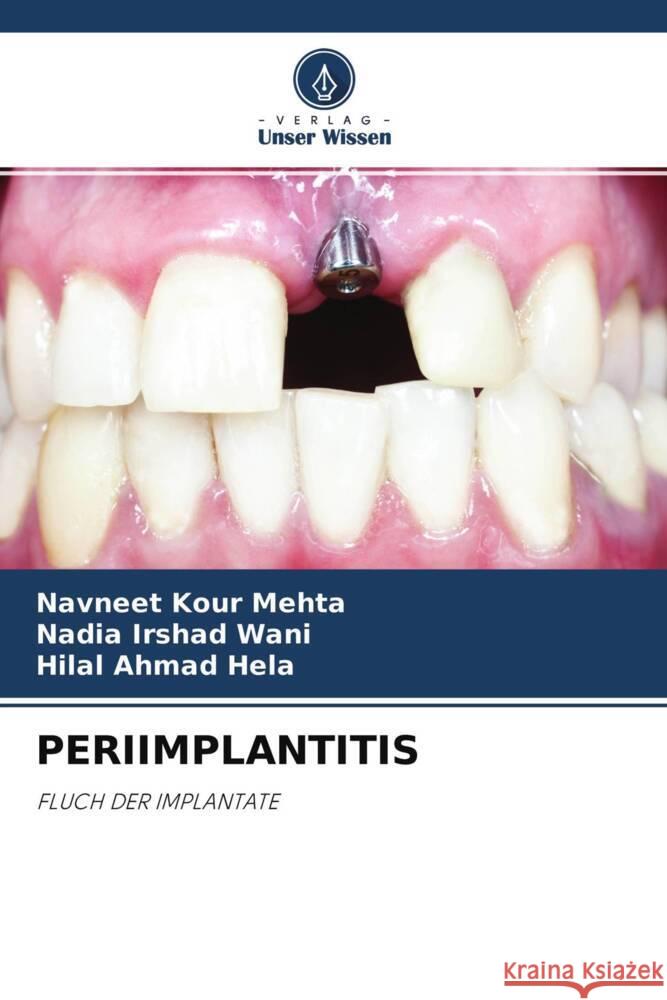 PERIIMPLANTITIS Kour Mehta, Navneet, Irshad Wani, Nadia, Ahmad Hela, Hilal 9786204254760