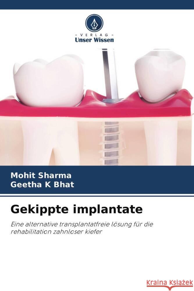 Gekippte implantate Sharma, Mohit, Bhat, Geetha K 9786204255743