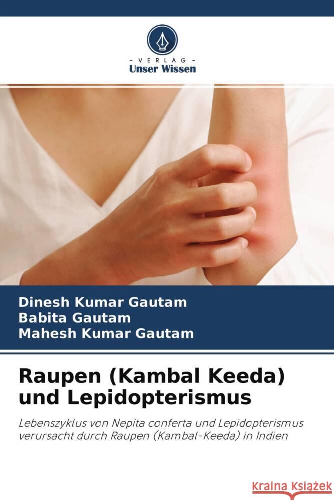 Raupen (Kambal Keeda) und Lepidopterismus Gautam, Dinesh Kumar, Gautam, Babita, Gautam, Mahesh Kumar 9786204314259