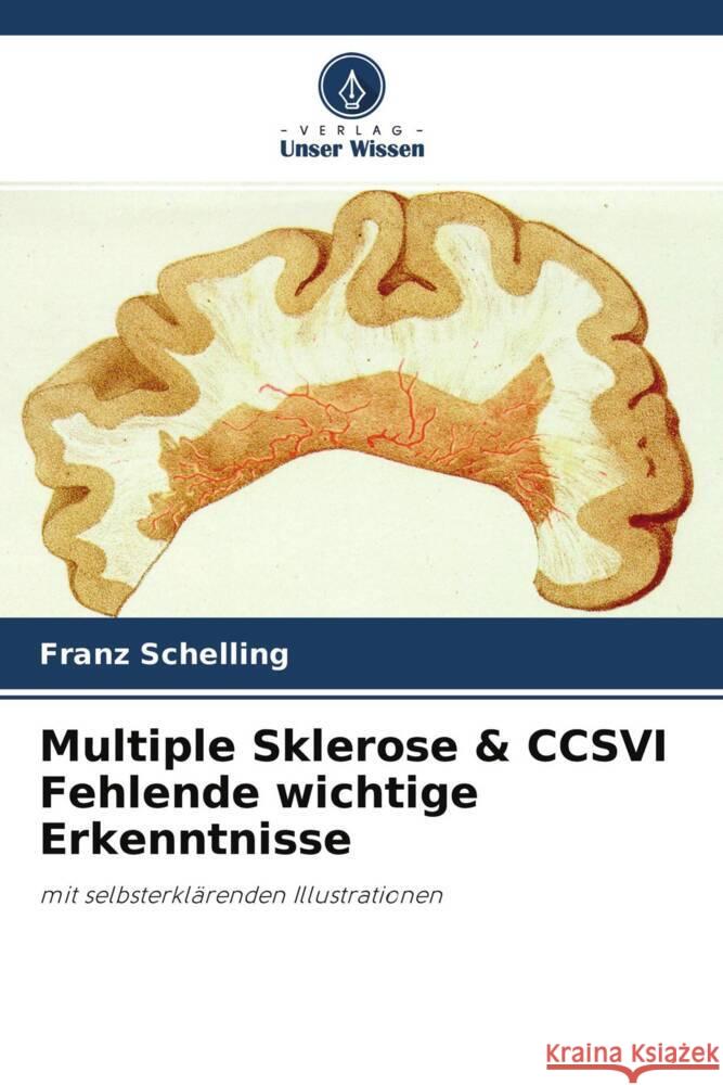 Multiple Sklerose & CCSVI Fehlende wichtige Erkenntnisse Schelling, Franz 9786204376356