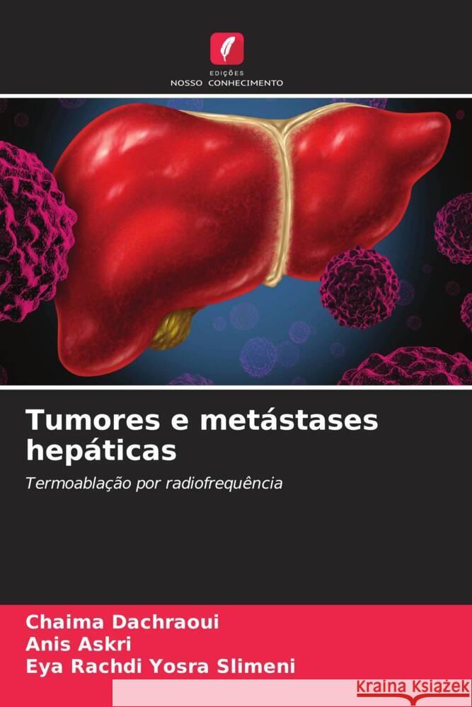 Tumores e metástases hepáticas Dachraoui, Chaima, Askri, Anis, Yosra Slimeni, Eya Rachdi 9786204376998