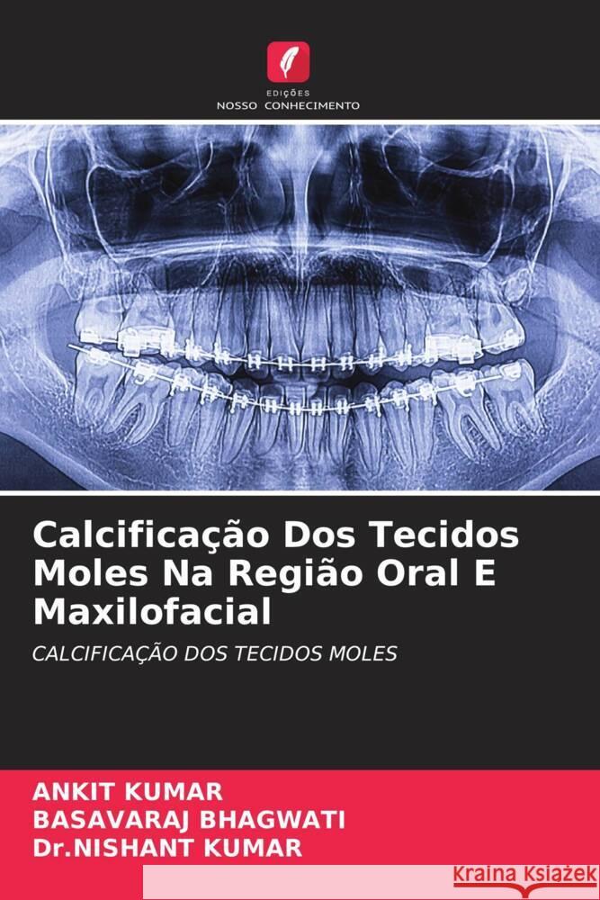 Calcificação Dos Tecidos Moles Na Região Oral E Maxilofacial Kumar, Ankit, Bhagwati, Basavaraj, Kumar, Dr.nishant 9786204403977 Edições Nosso Conhecimento