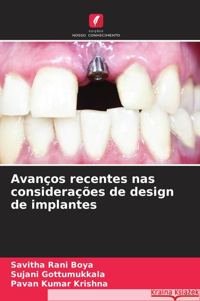 Avanços recentes nas considerações de design de implantes Boya, Savitha Rani, Gottumukkala, Sujani, Krishna, Pavan Kumar 9786204409870